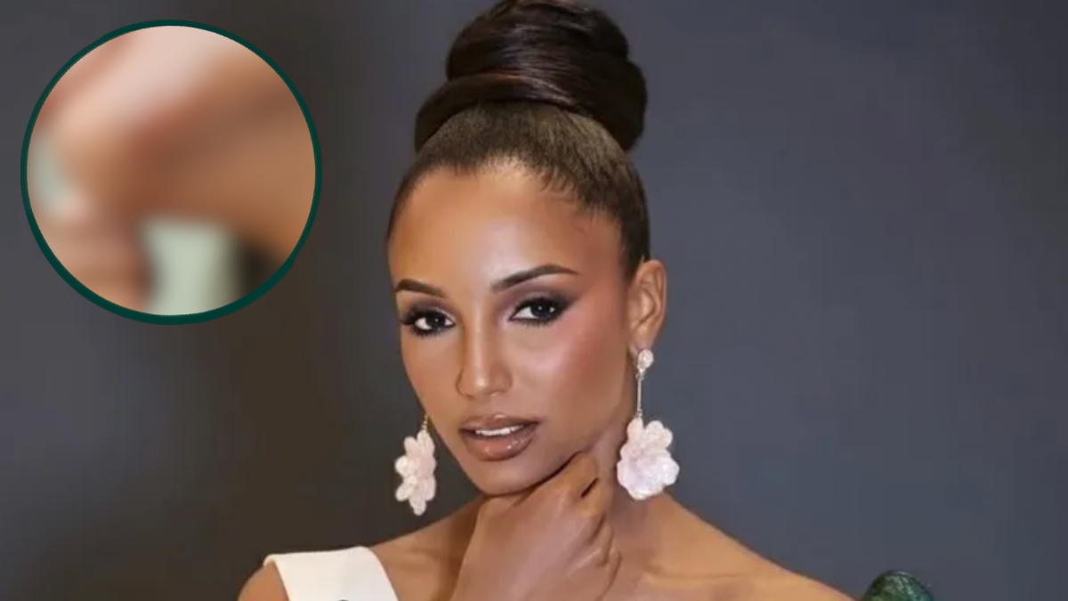 Miss Jamaica muestra las cicatrices que dejó su aparatosa caída en pleno Miss Universe: ¿Desfigurada? FOTOS