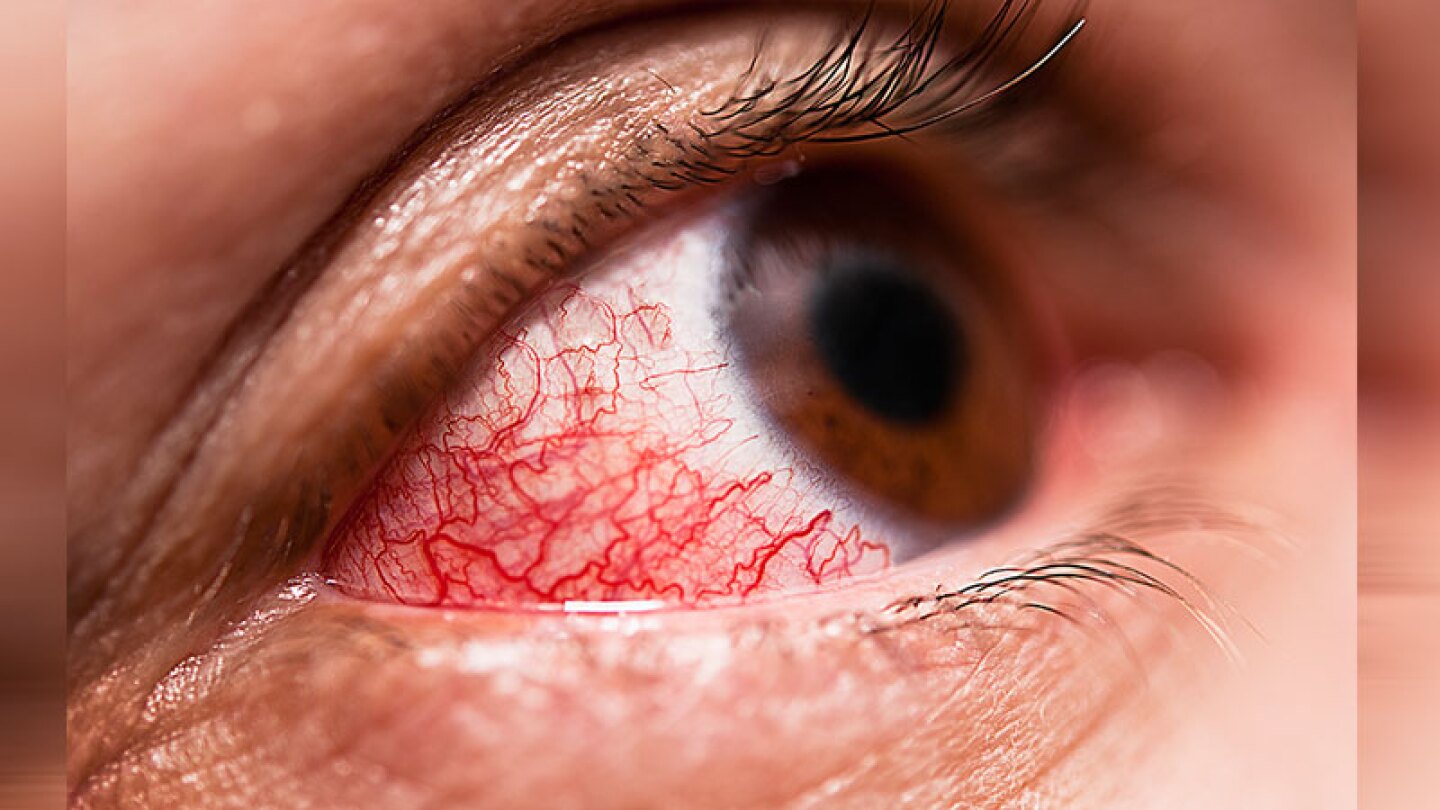 Mejora la conjuntivitis
