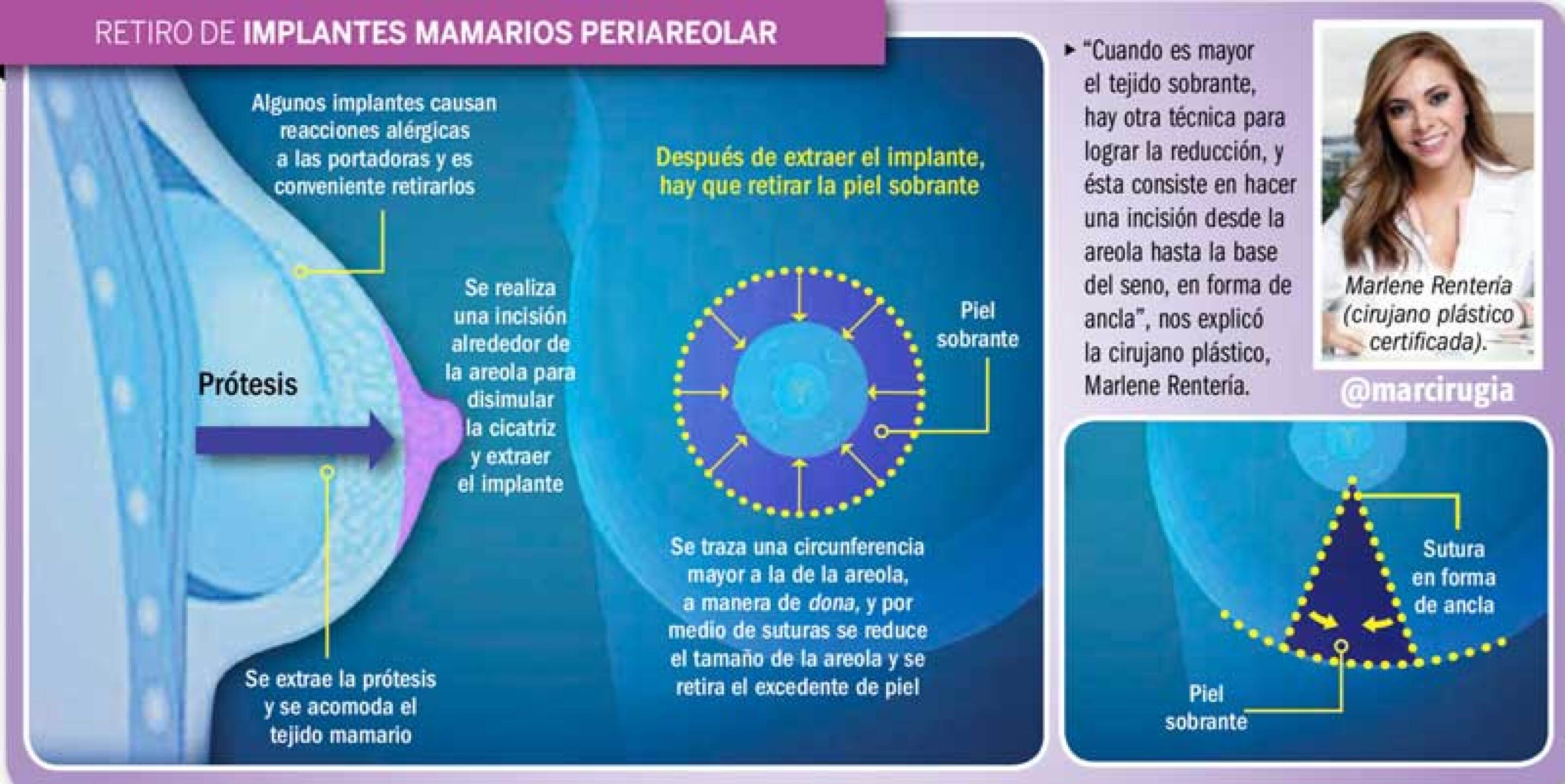 Verónica Montes se quitó los implantes de pecho