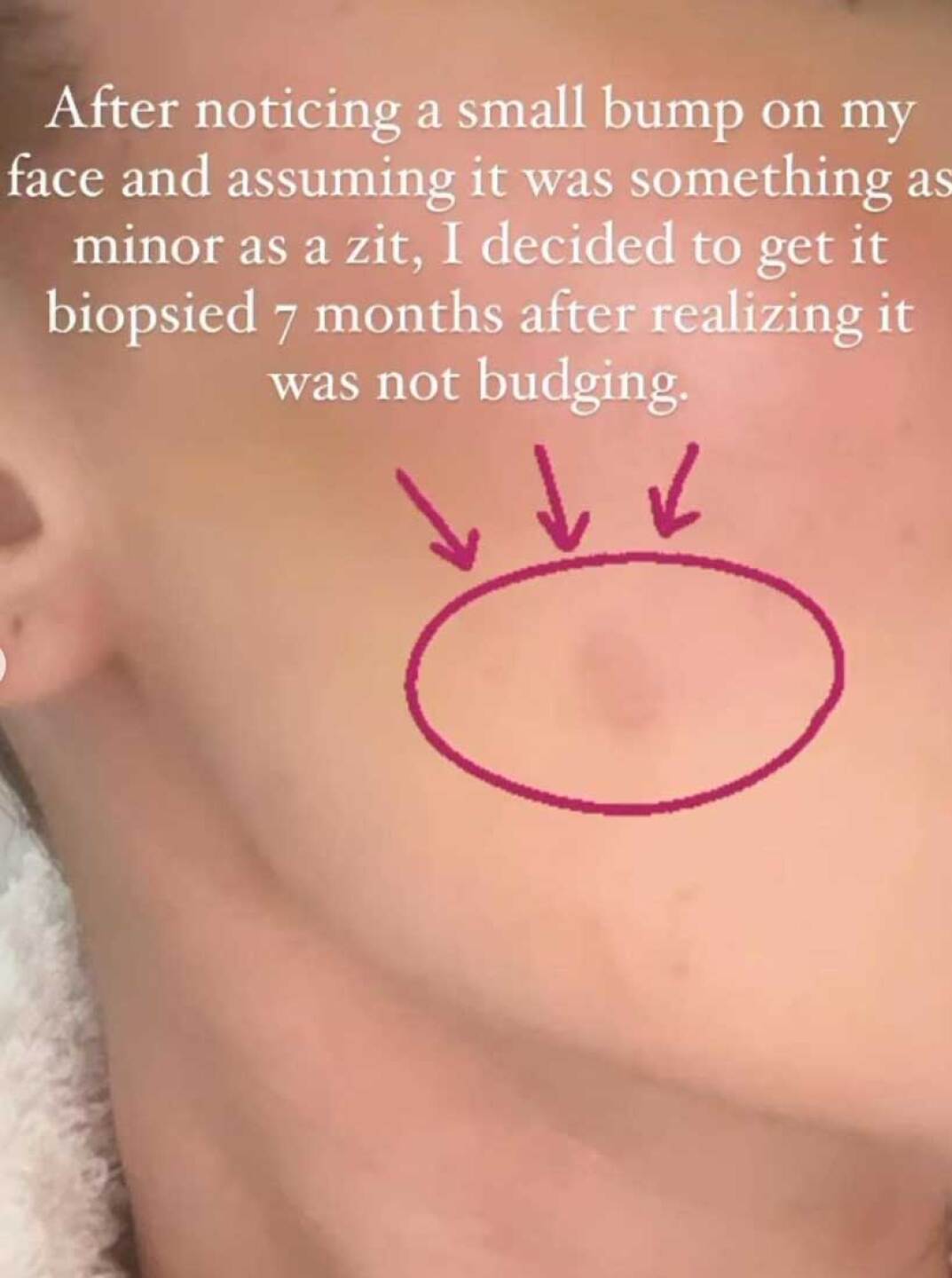Khloé Kardashian comparte diagnóstico de cáncer de piel