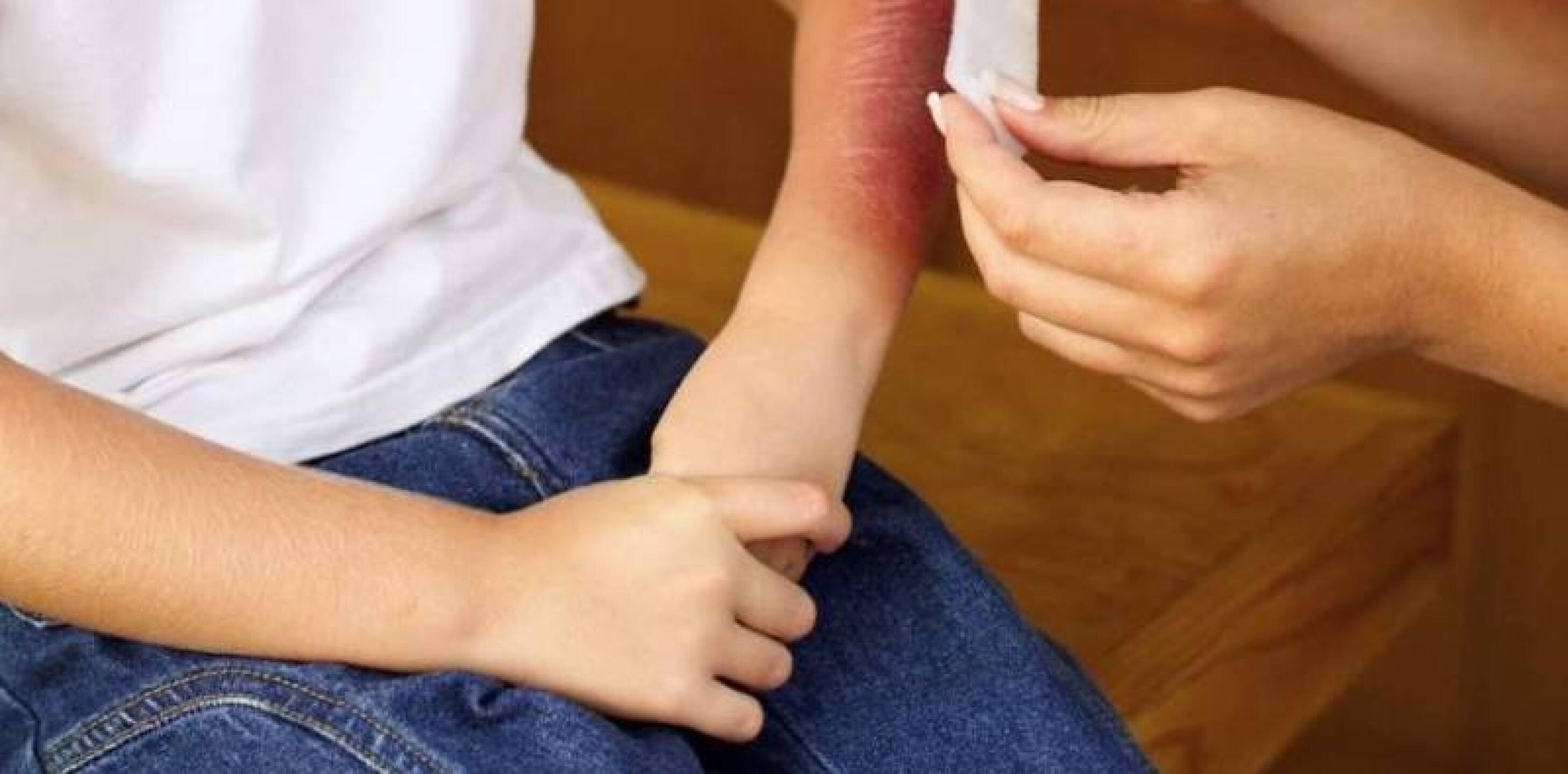 Quemaduras primer grado