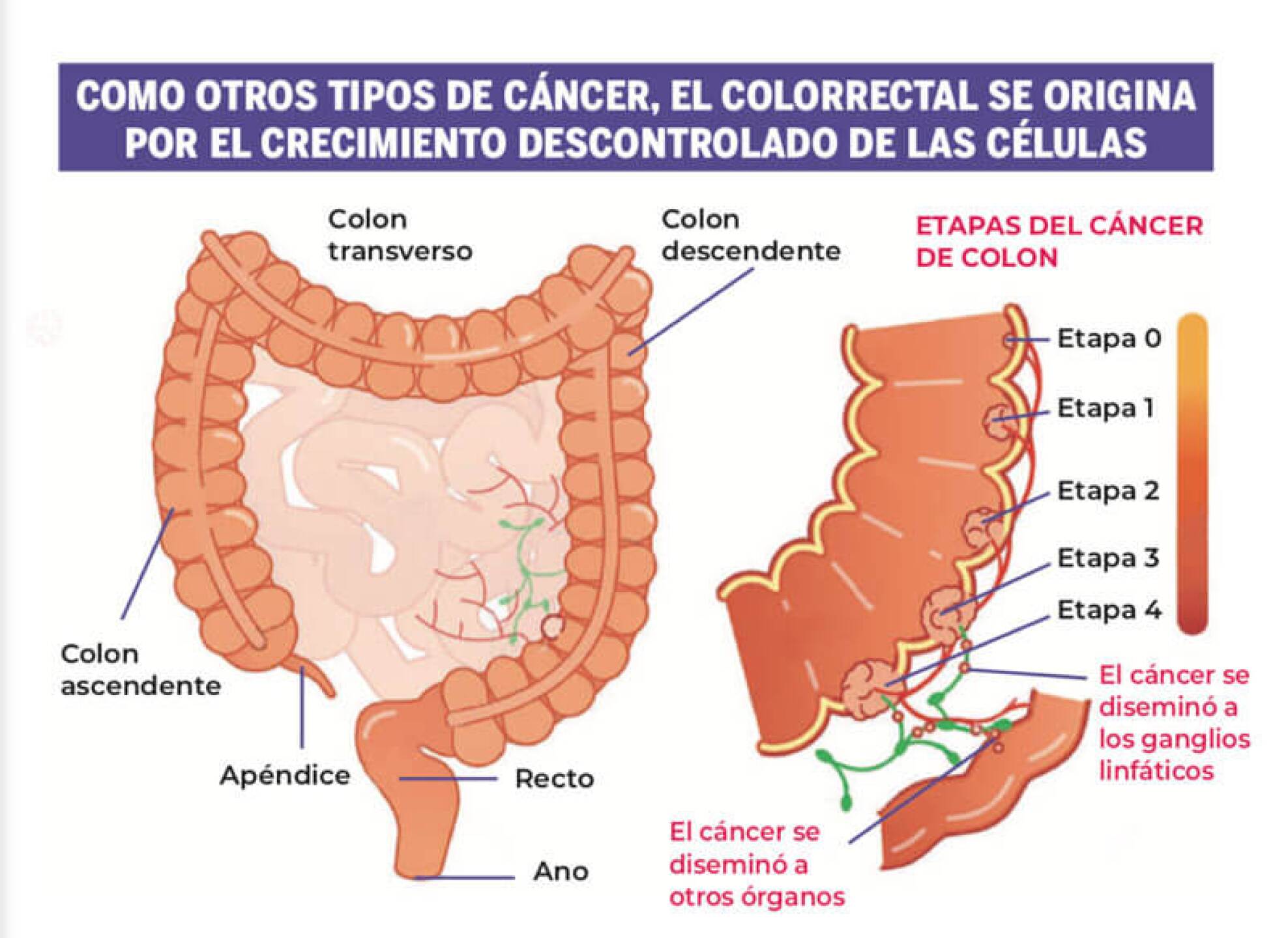 Cáncer de colón enfermedad que afecta también a los jóvenes