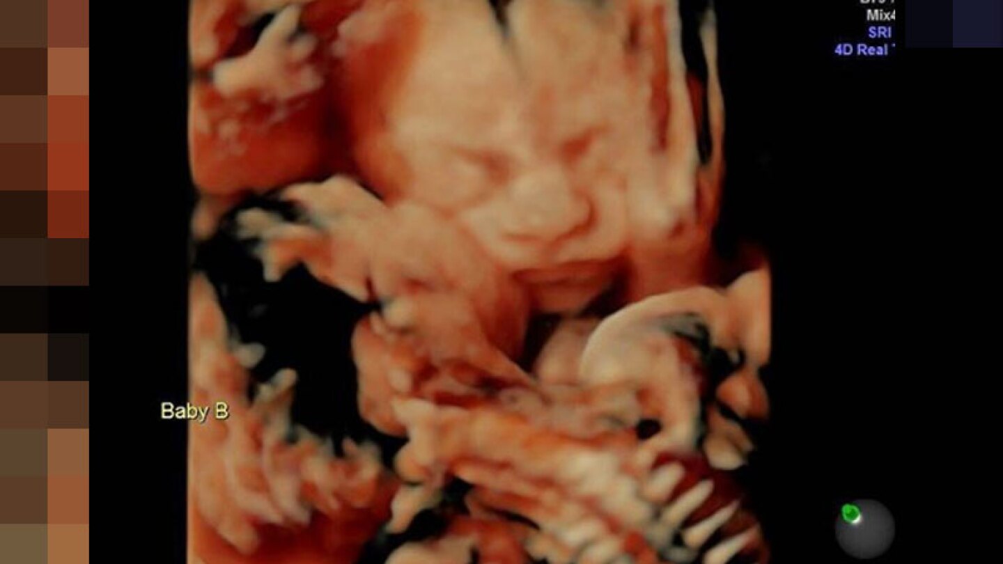 Gemelas se dan un tierno meso en su ultrasonido