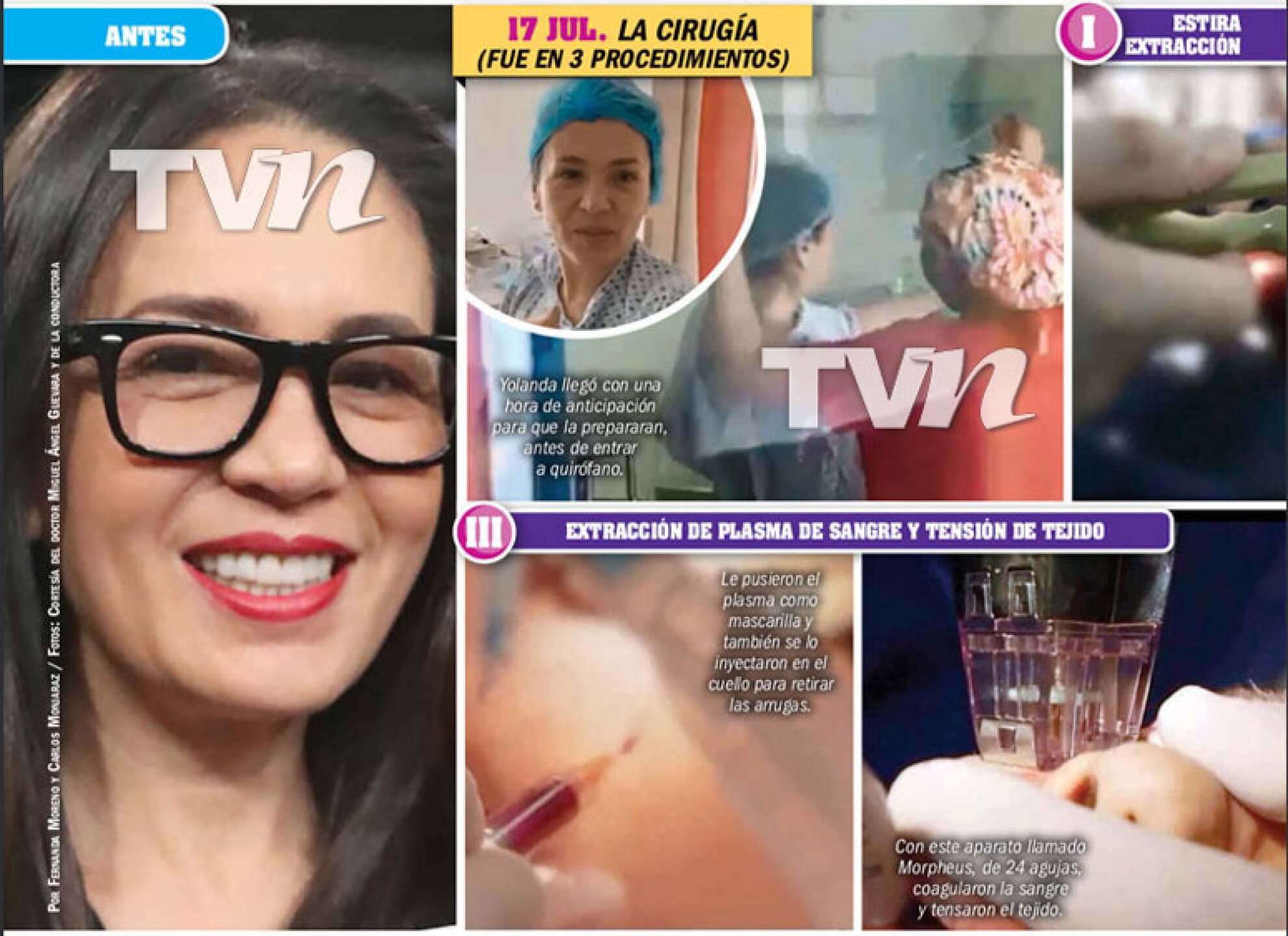 yolanda andrade cirugía rejuveneció