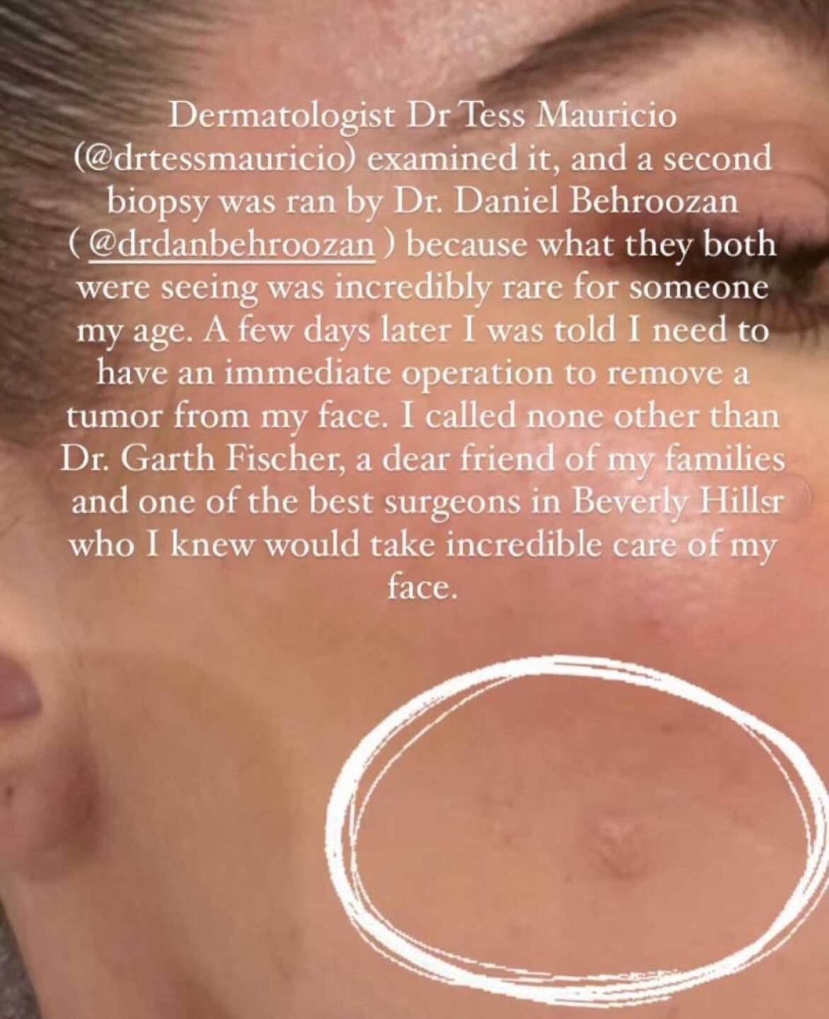 Khloé Kardashian comparte diagnóstico de cáncer de piel