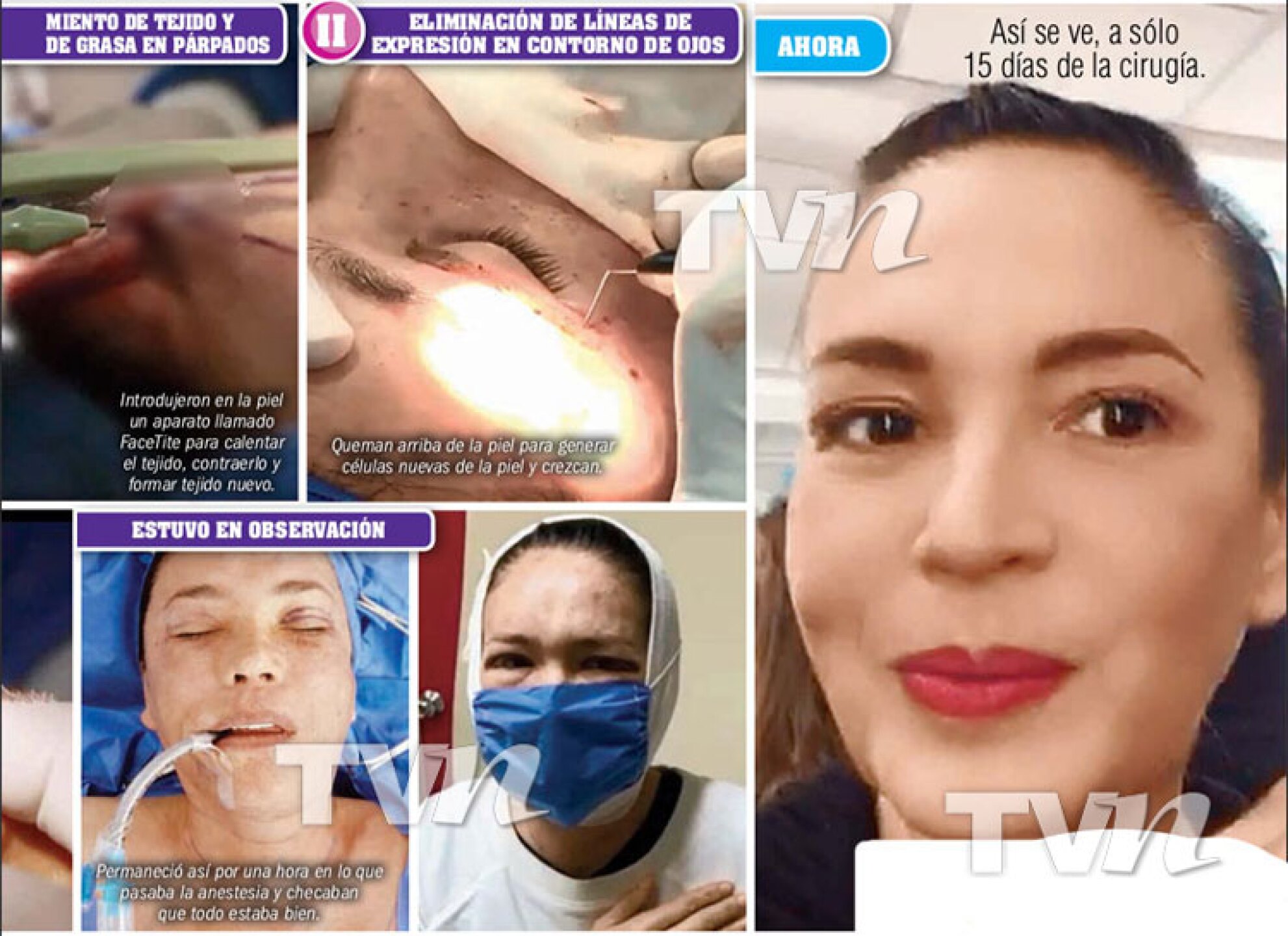 yolanda andrade cirugía rejuveneció