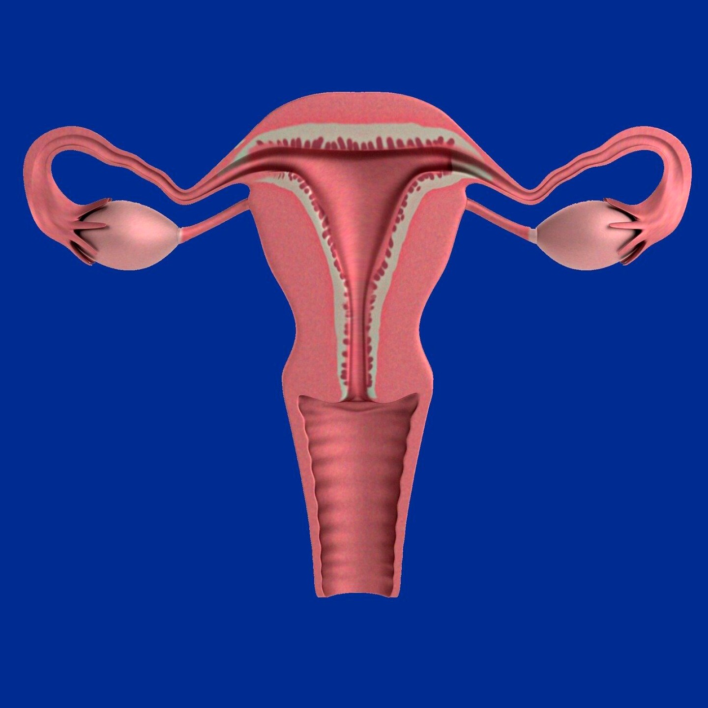 Síntomas del Cáncer Ovario