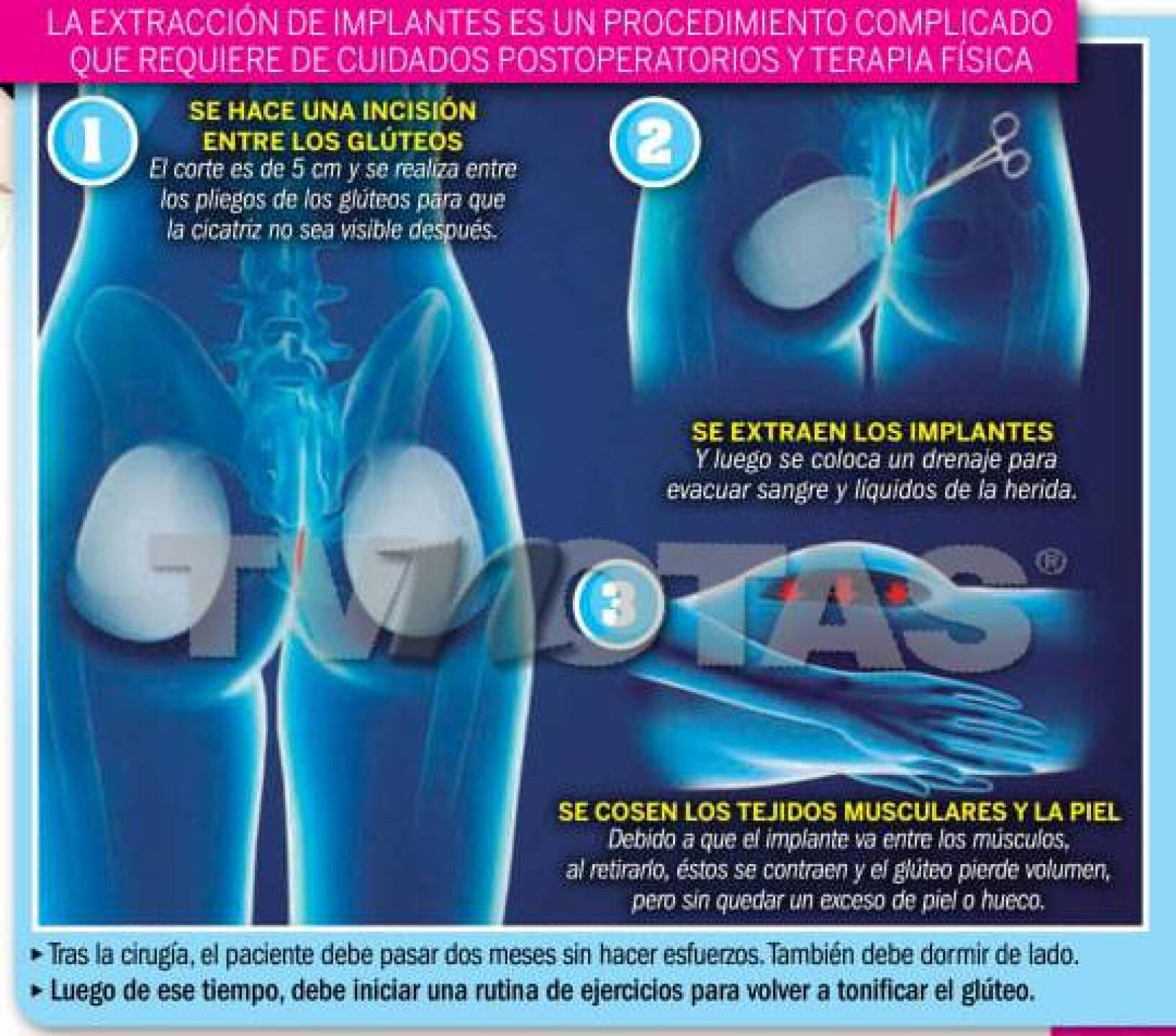 Gomita cirugía