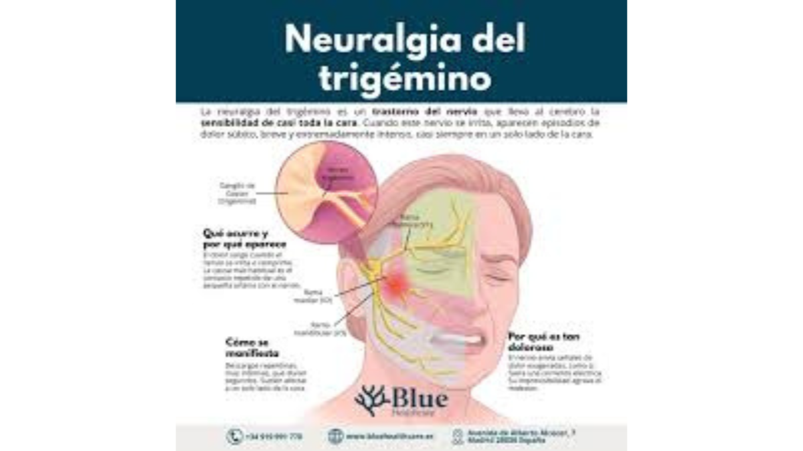 neuralgia del trigémino