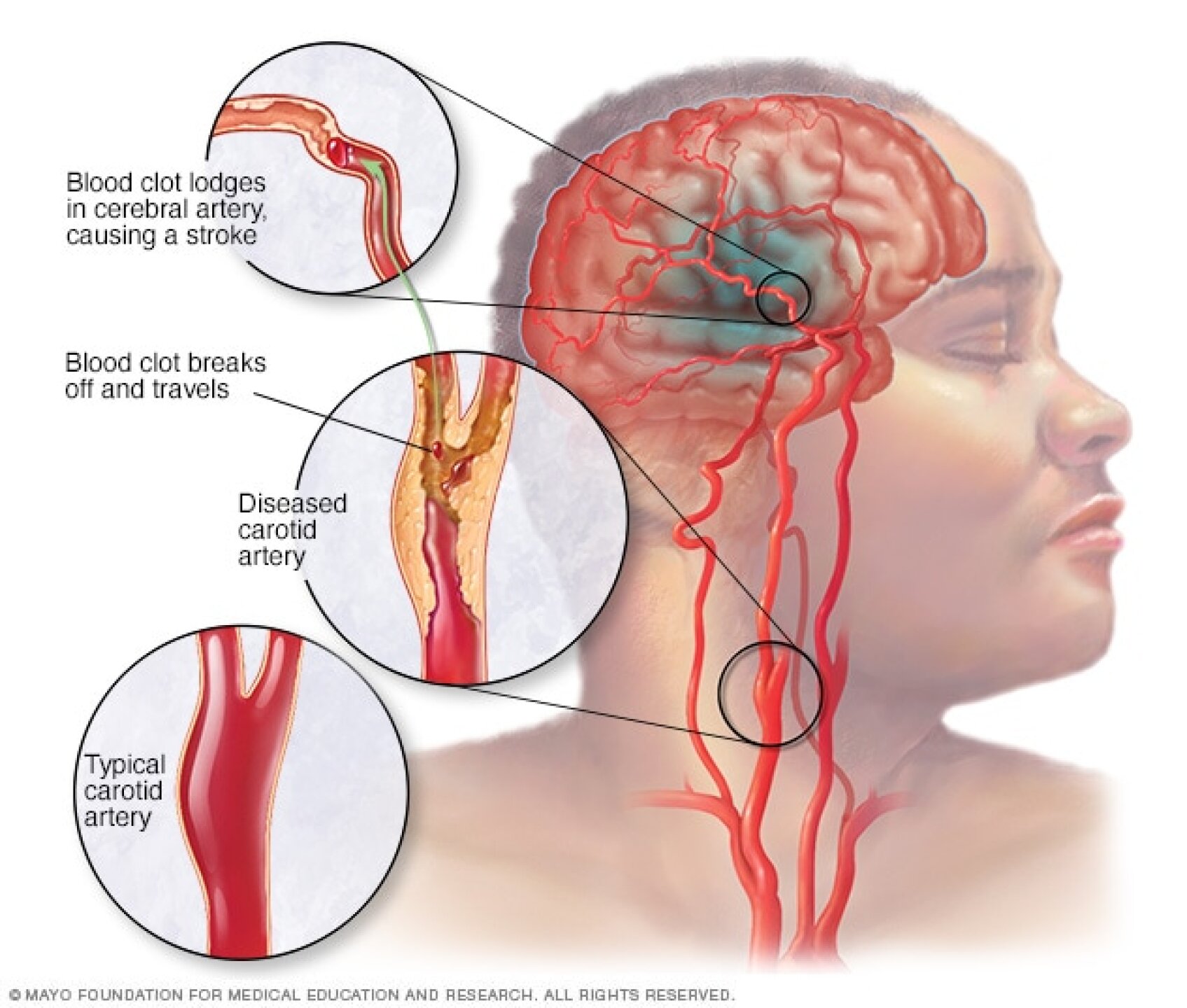 Qué es un infarto cerebral infografía