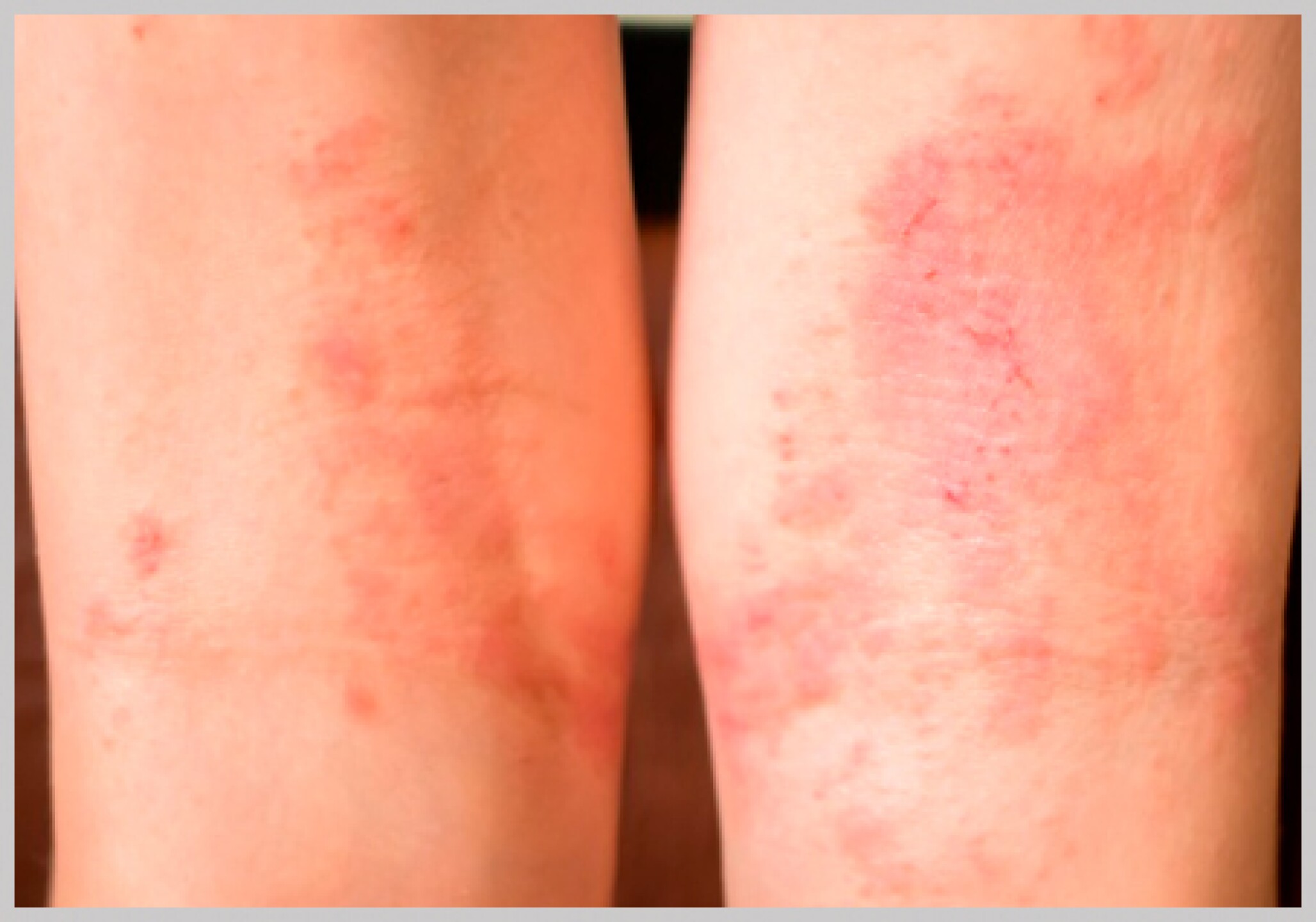 Dermatitis nerviosa estrés ansiedad