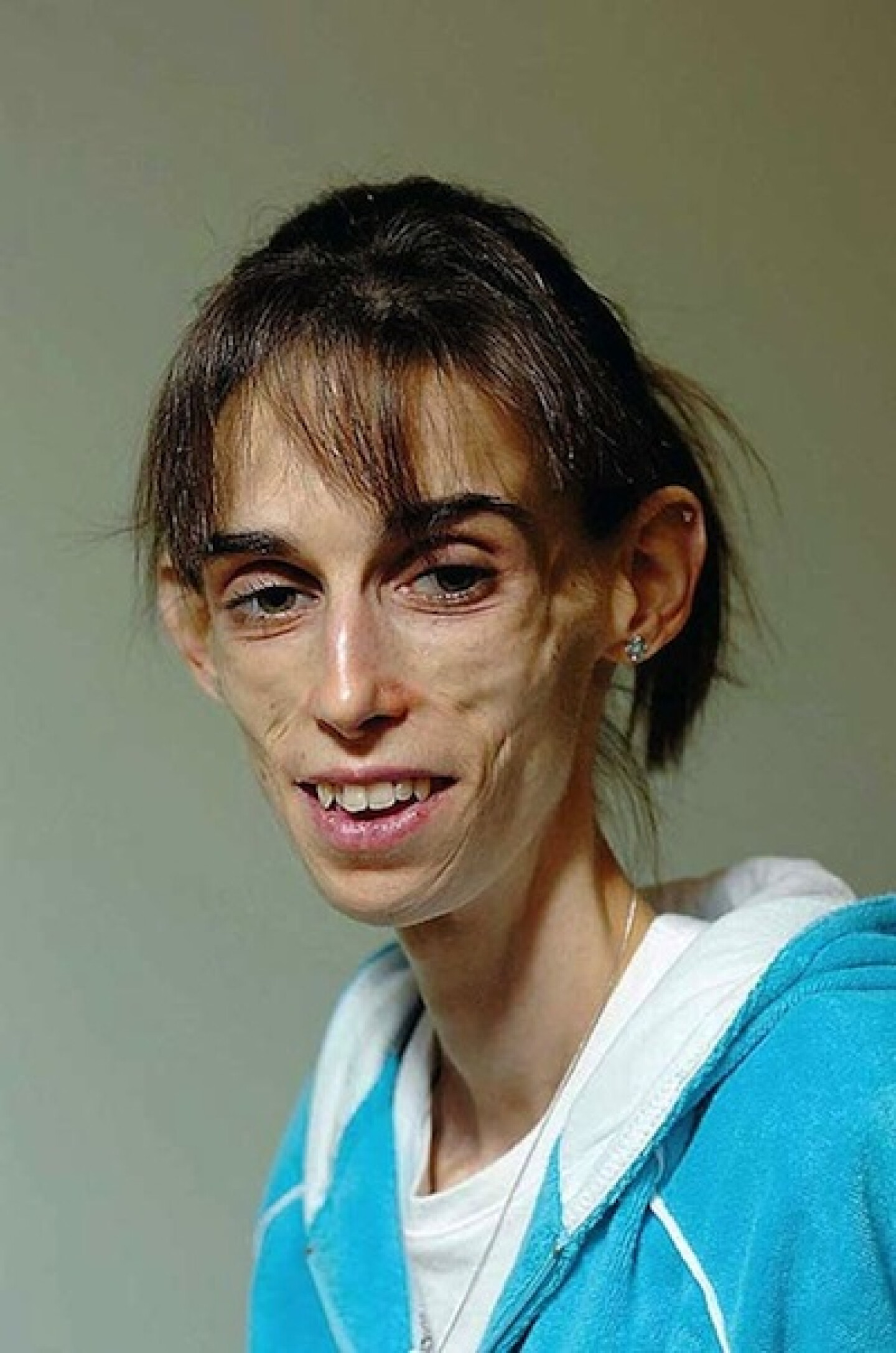 Kate Chilver Kate Chilver: el peor caso de anorexia que se ha visto