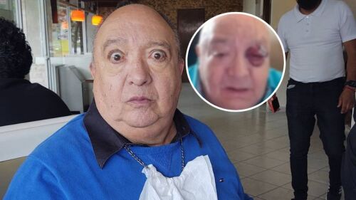 Luis de Alba apuntó de perder el ojo, tras trágica caída en donde su rodilla fue expuesta