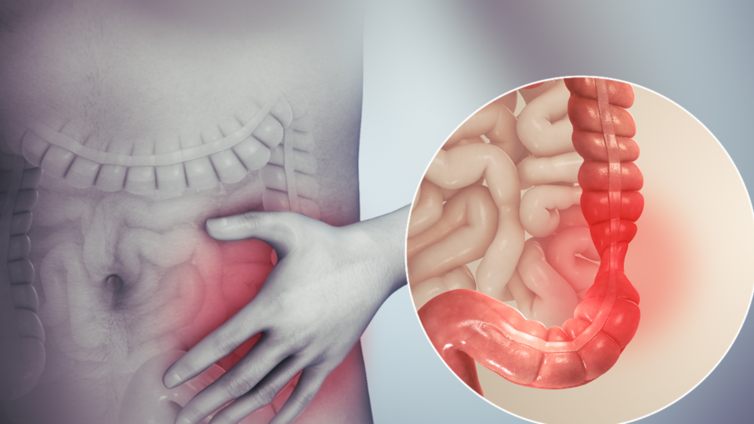 síndrome de colon irritable