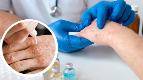 Lepra en México: síntomas, tratamiento y cómo se transmite