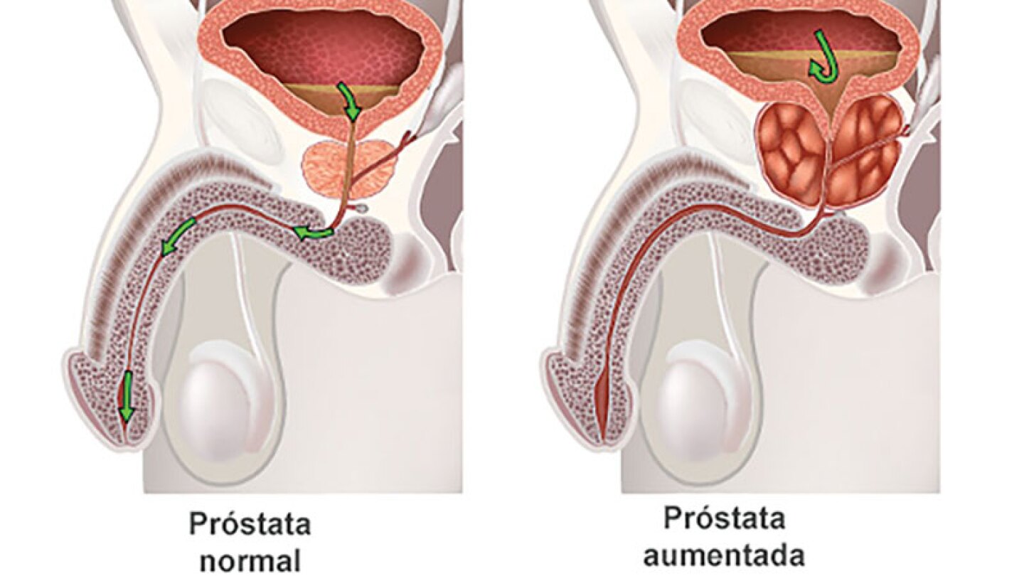 El Doctor Abel te recomienda tomar un licuado de espárrago con jugo de naranja, ajo, papaya y guanábana.