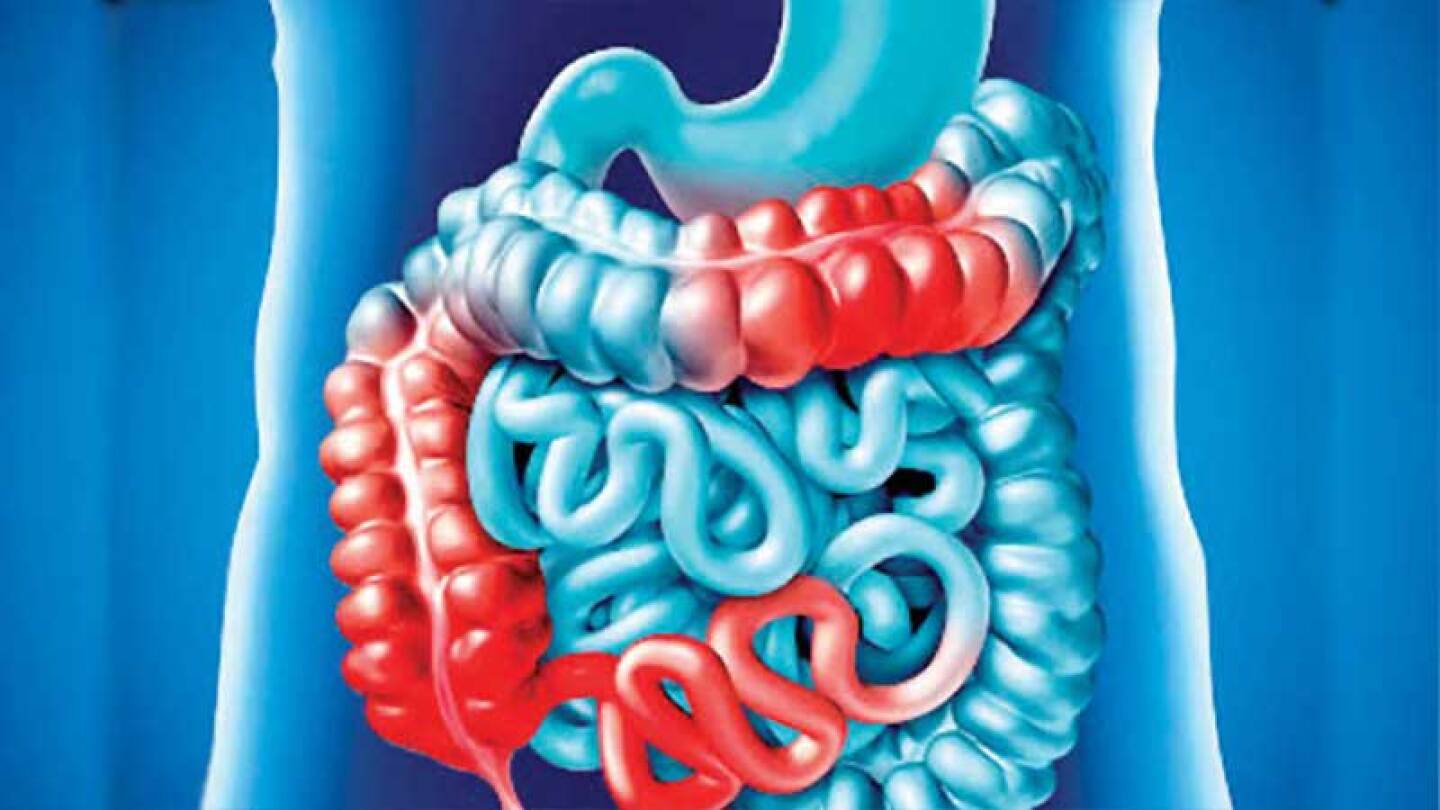 La enfermedad de Crohn efecta a muchas personas