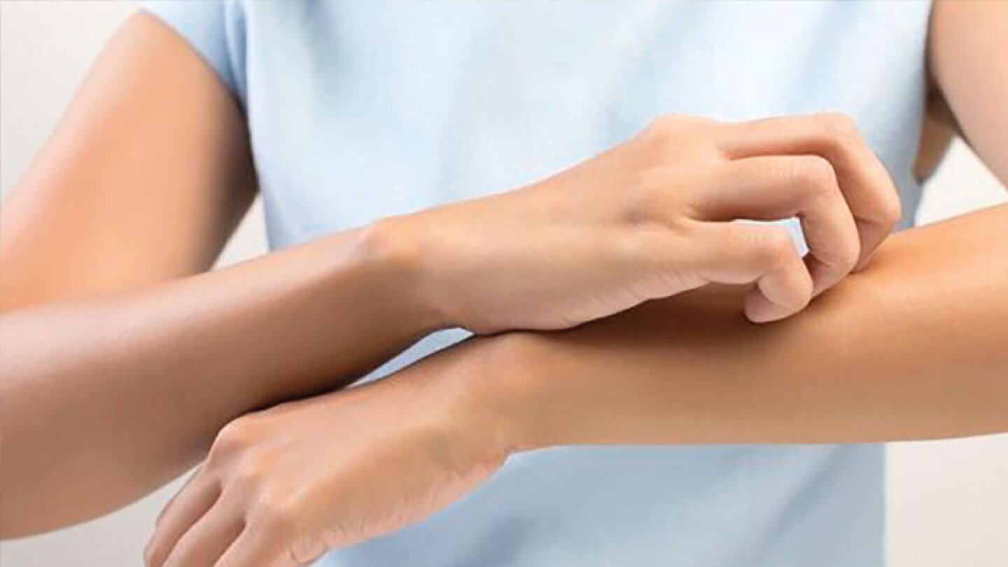 Para aliviar las molestias que causa la colestasis, te recomiendo tomar una infusión de boldo, yerbabuena, cuachalalate y valeriana, diariamente durante un mes.