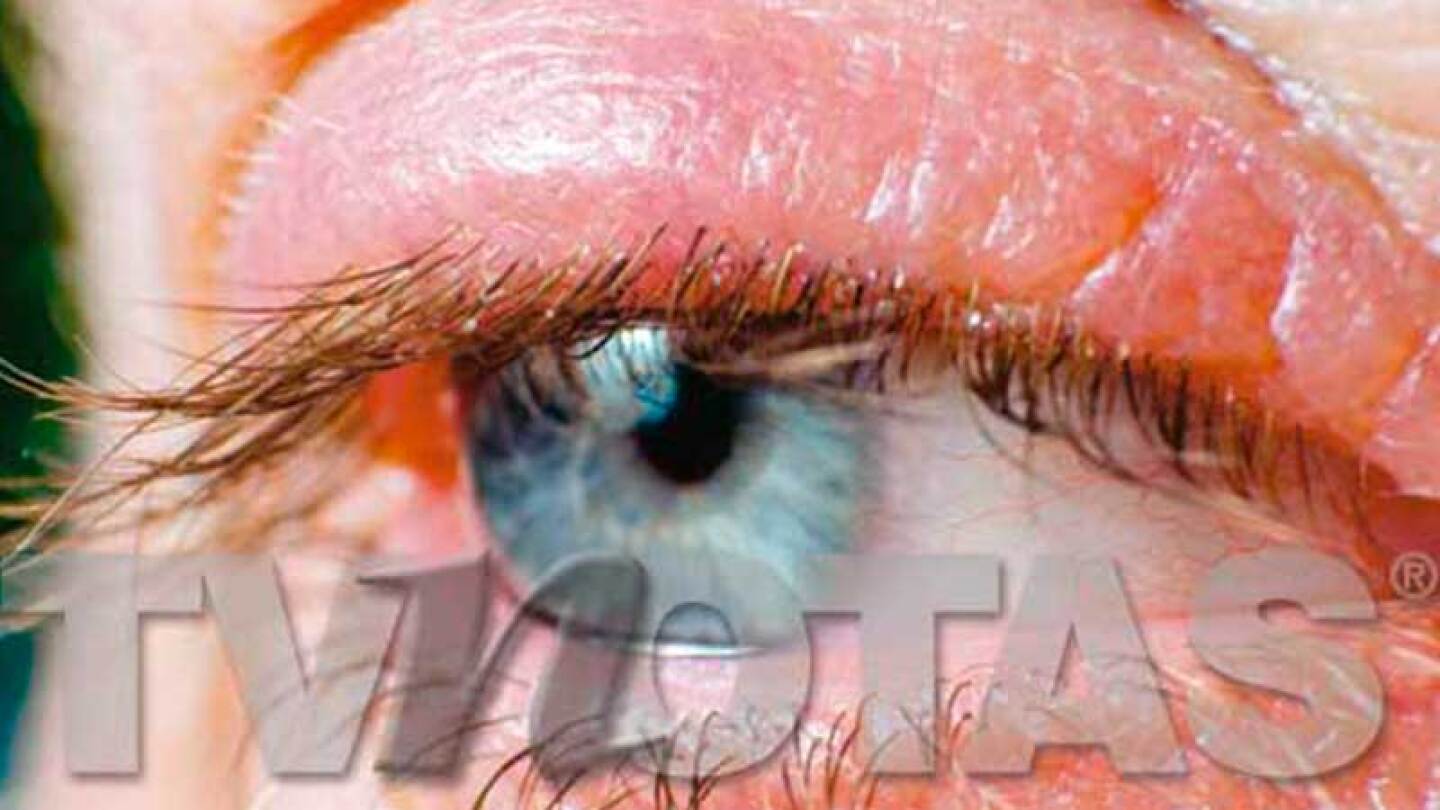 Dismuye las molestias en los ojos por biefaritis