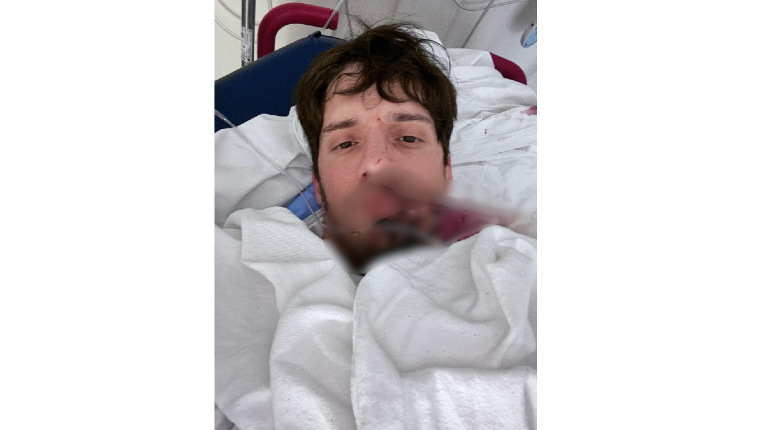 El actor LGBT de contenido exclusivo presenta complicaciones en el rostro.