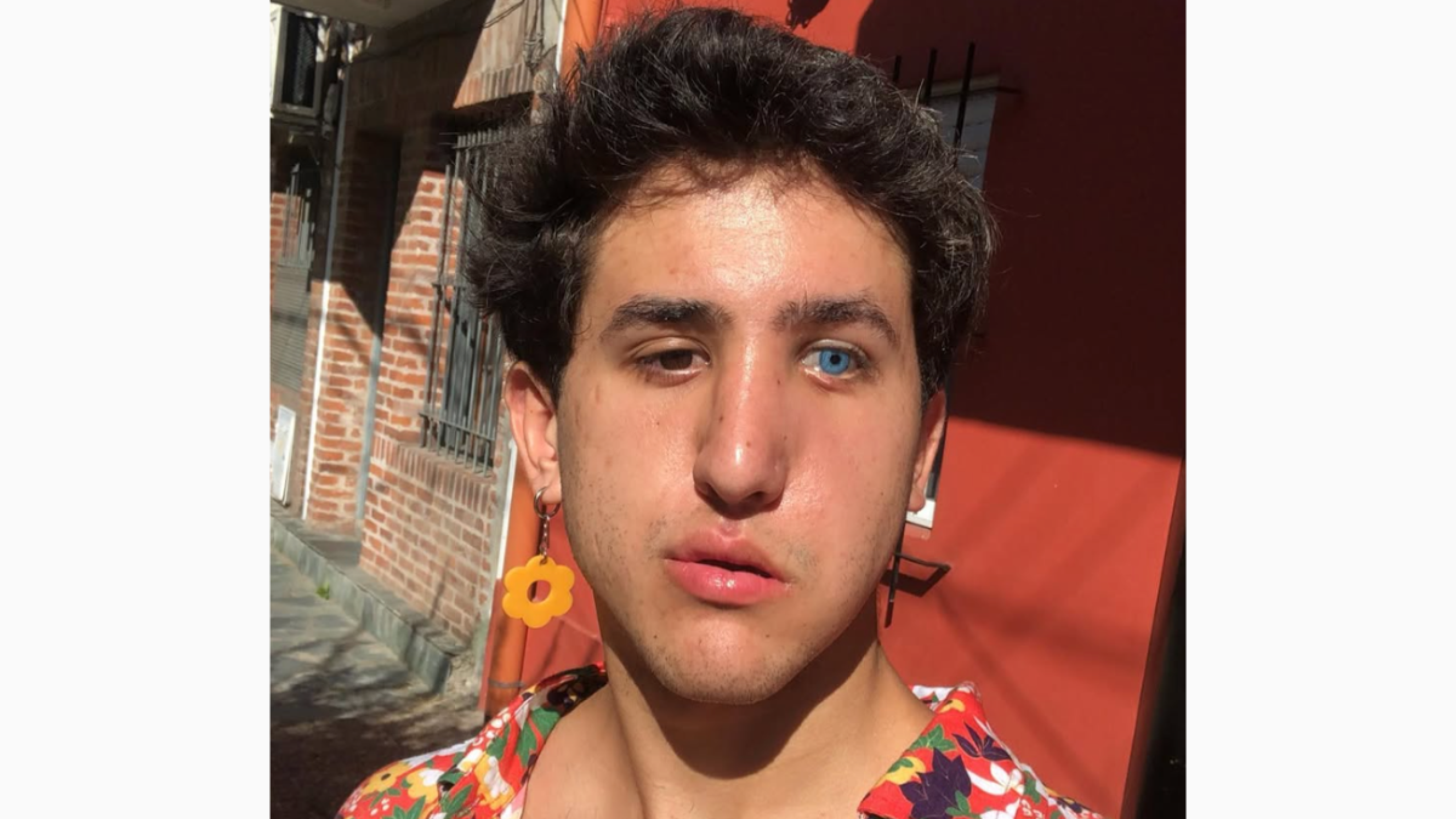 Joaquín Acebo reveló consecuencias del accidente que sufrió durante su infancia.png