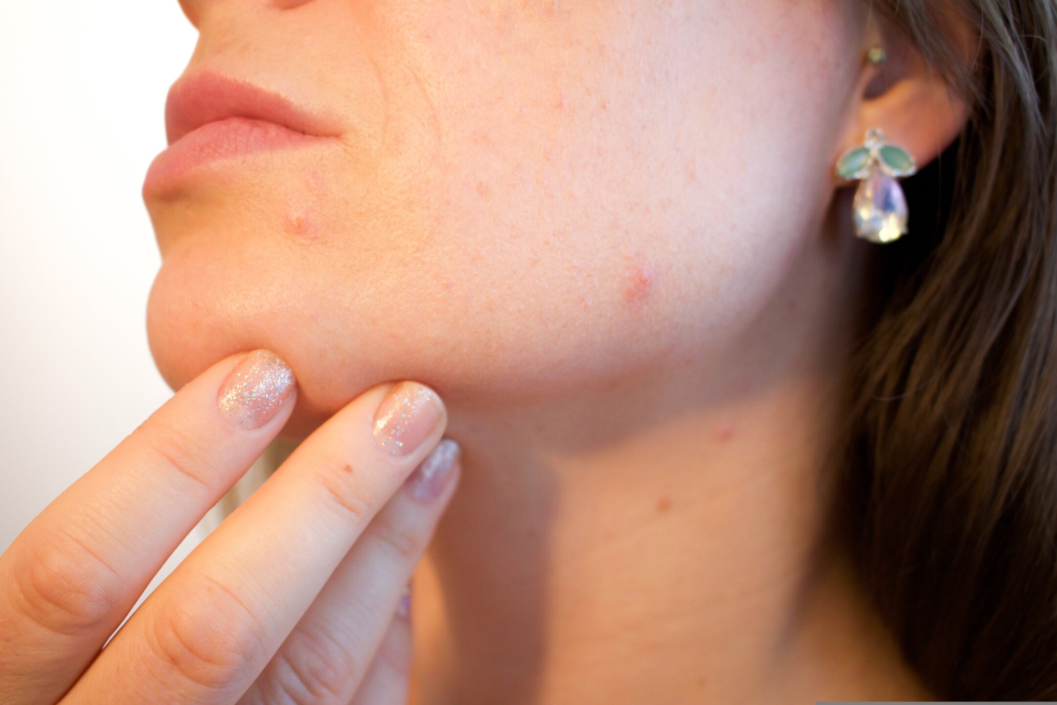 mascarilla que elimina el acné
