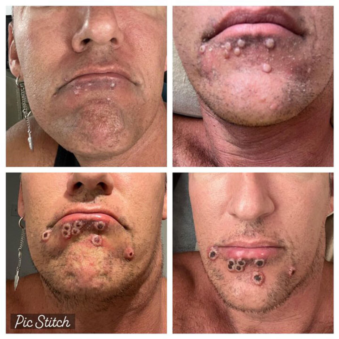 Mala suerte nivel Dios: Hombre se contagia de Covid-19, viruela del mono y VIH al mismo tiempo