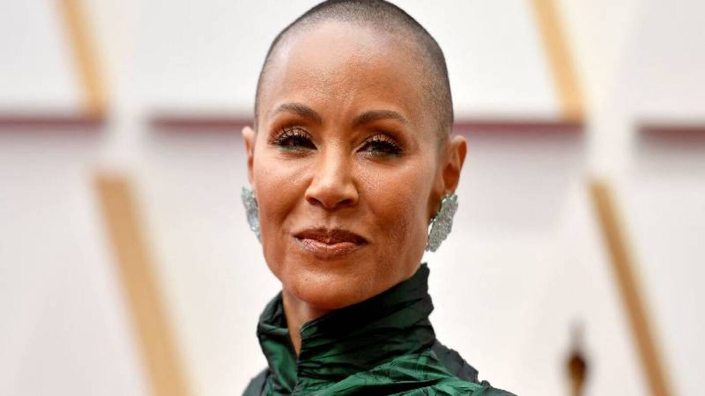 Alopecia femenina