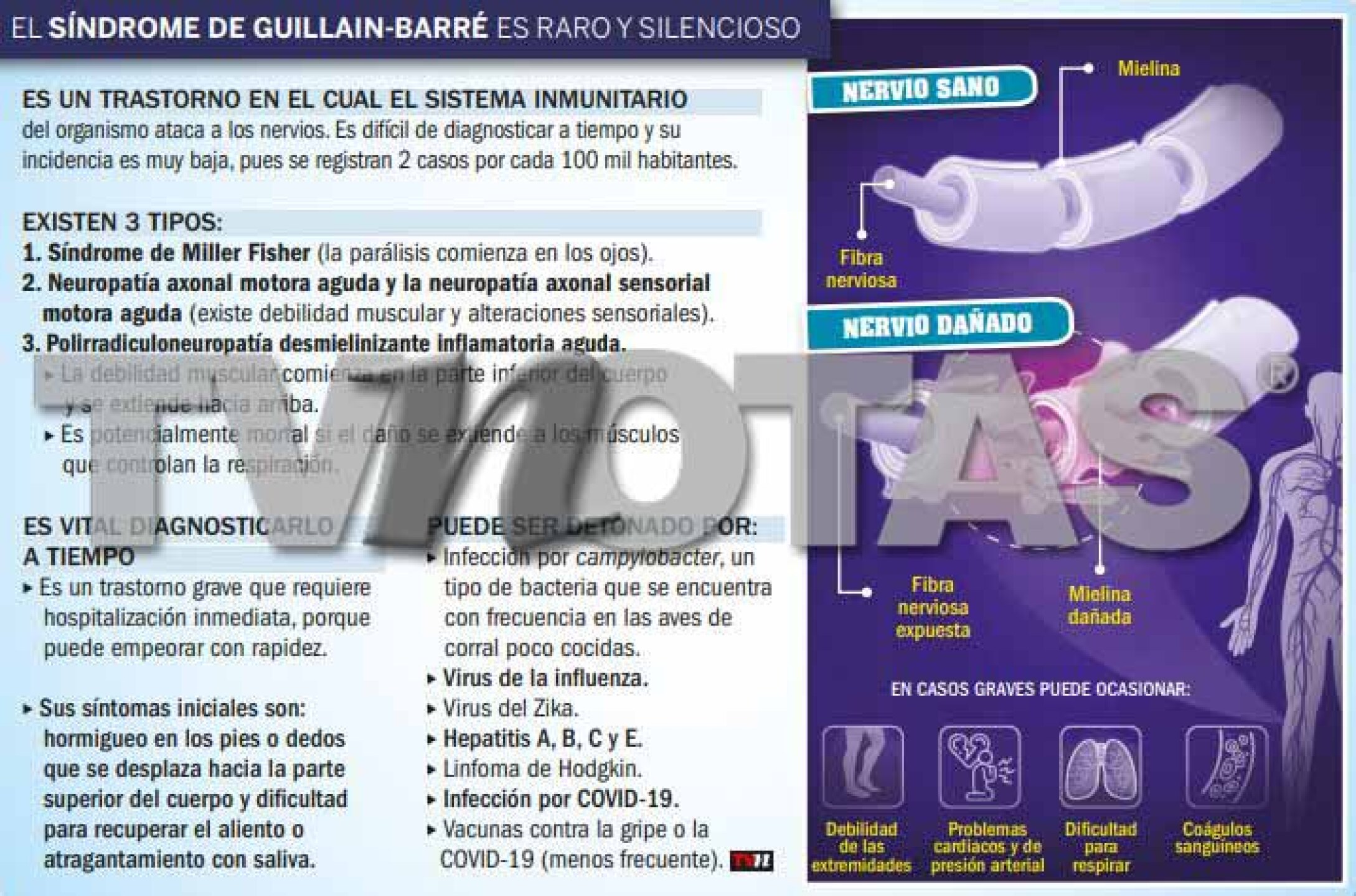 ¿Qué es el síndrome Guillain-Barré?