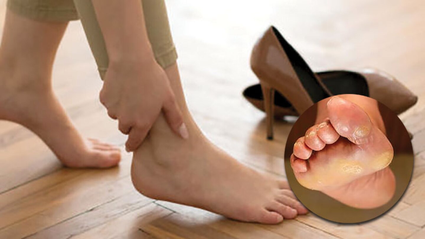 Para que esos callos no te molesten, es recomendable darte baños de pies con árnica y otros consejos que el Doctor te aconseja.