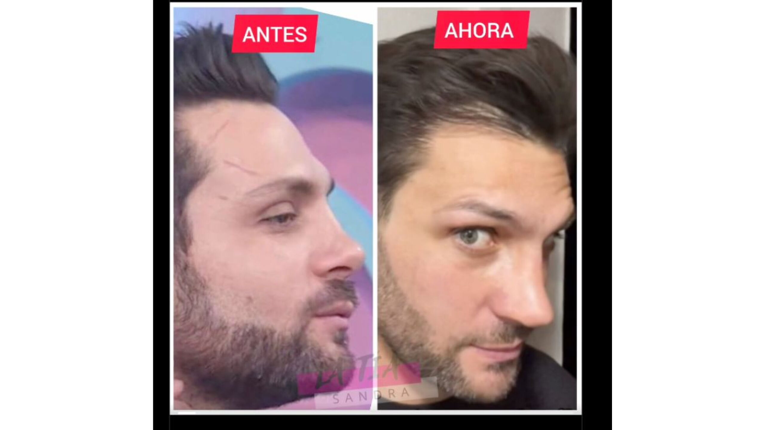 Nicola Porcella, antes y despues