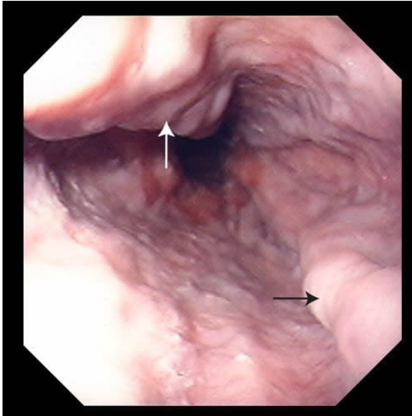 Endoscopia que muestra una várice esofágica