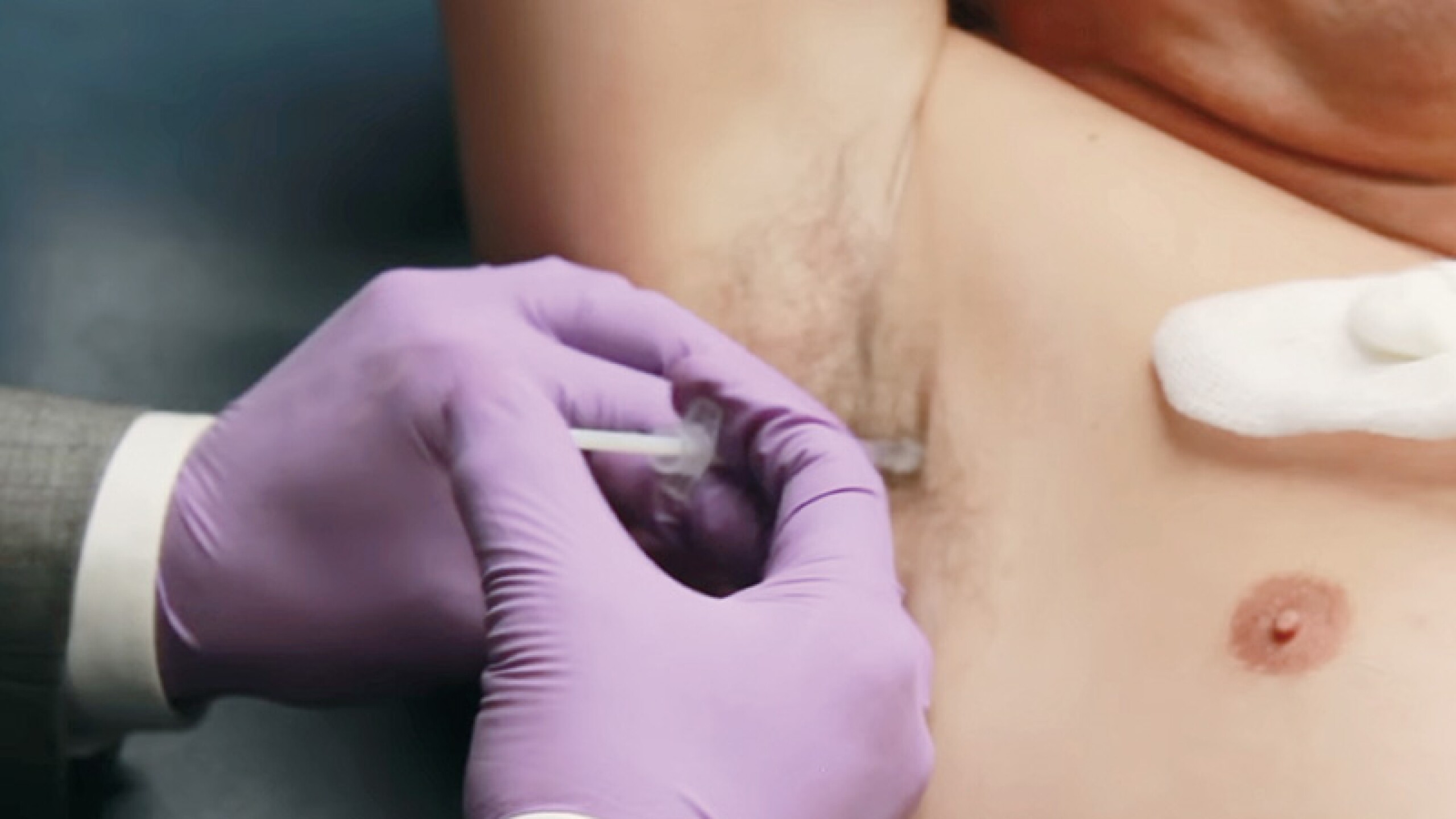 La hiperhidrosis lo hacía sudar sin control