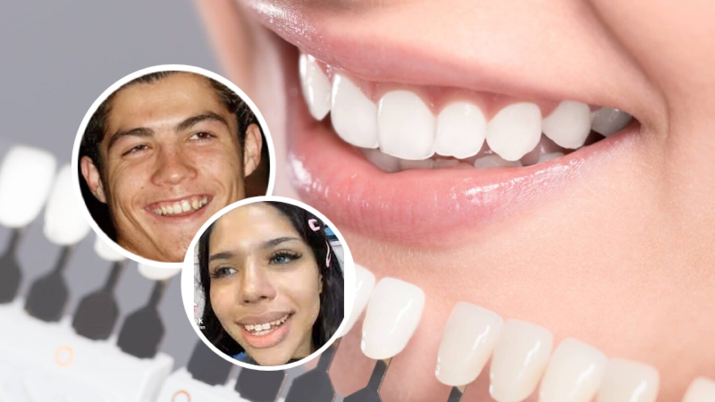 La carillas dentales arreglan problemas estéticos como la alineación, el tamaño o el color de los dientes.