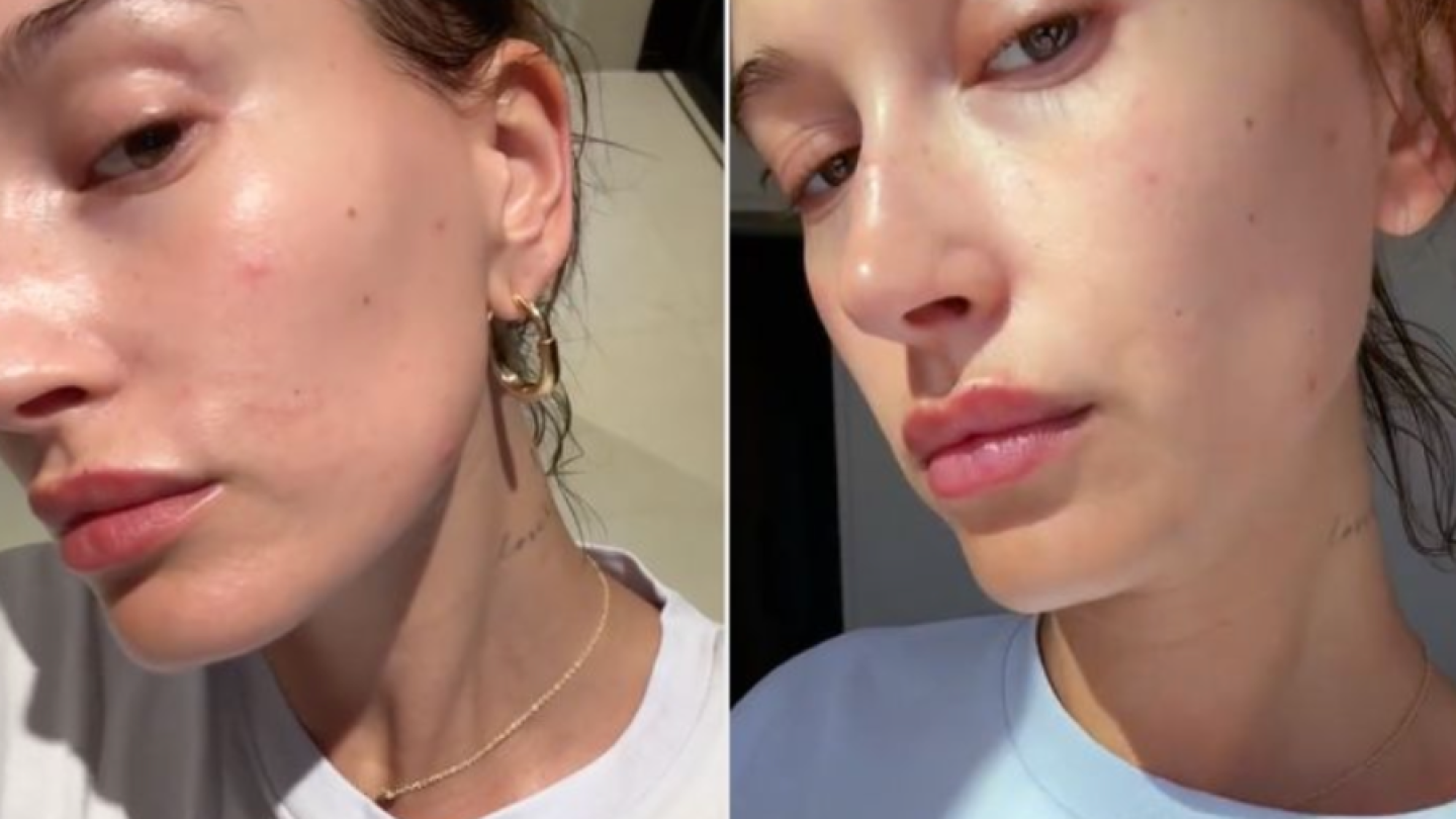 Hailey Bieber con erupciones rojas en la cara.png