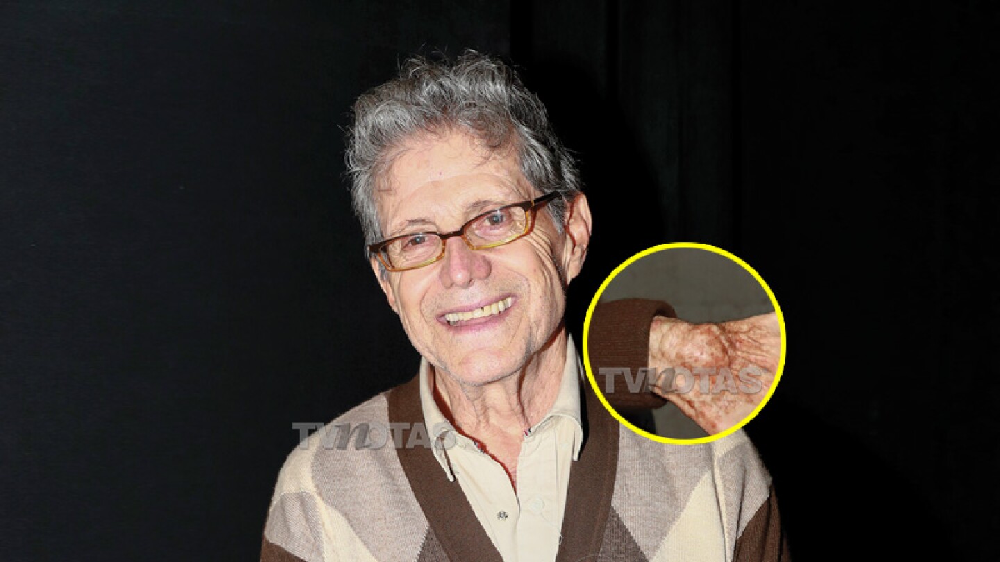 Héctor Bonilla tiene en la mano un tumor de 6 centímetros ¡desde hace un año!