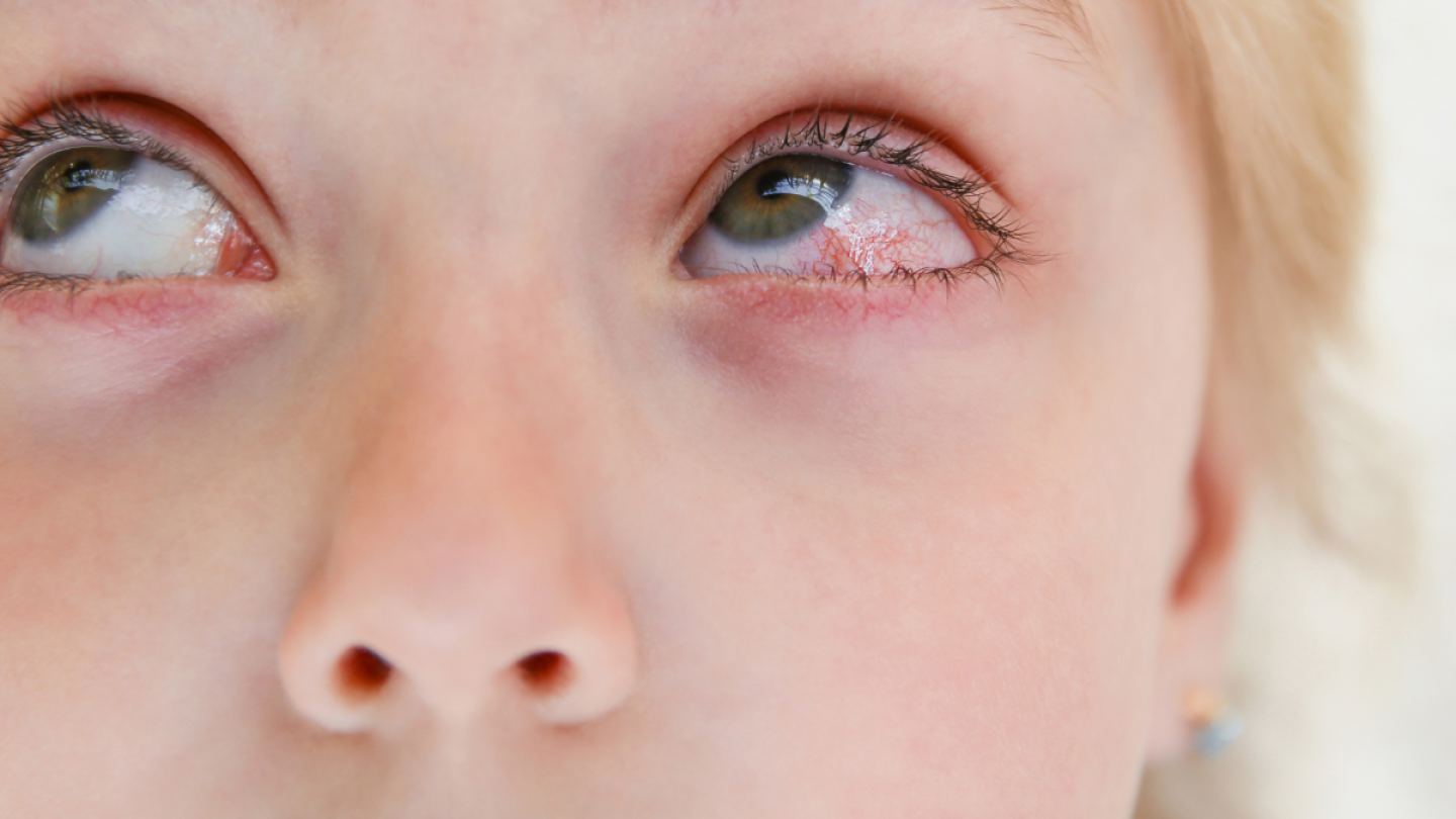 Ojo herido
