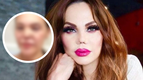 Carmen Campuzano reaparece tras cirugía en la nariz