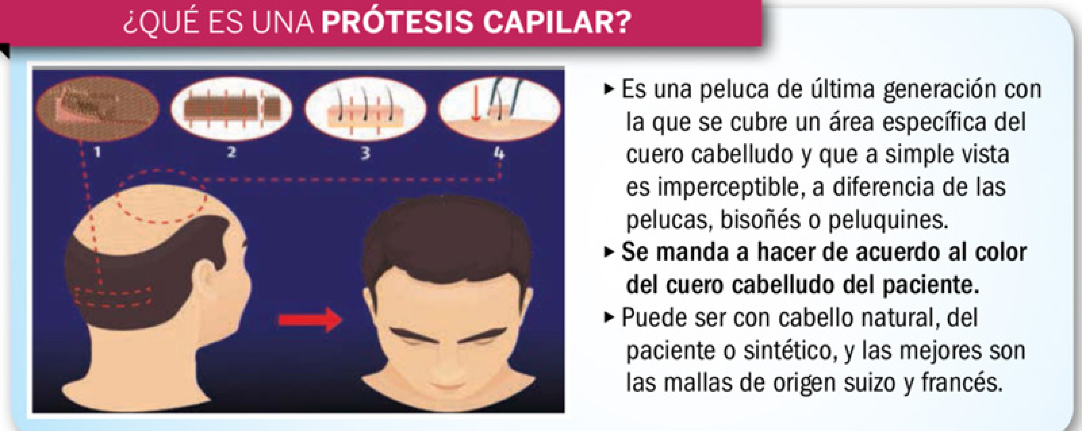 Sergio DeFassio se puso un injerto de cabello