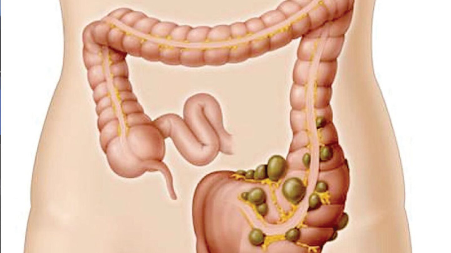 El Doctor Abel te recomienda tomar un licuado de papaya, jugo de naranja, nopal y agua, diariamente en ayunas, durante 2 meses.