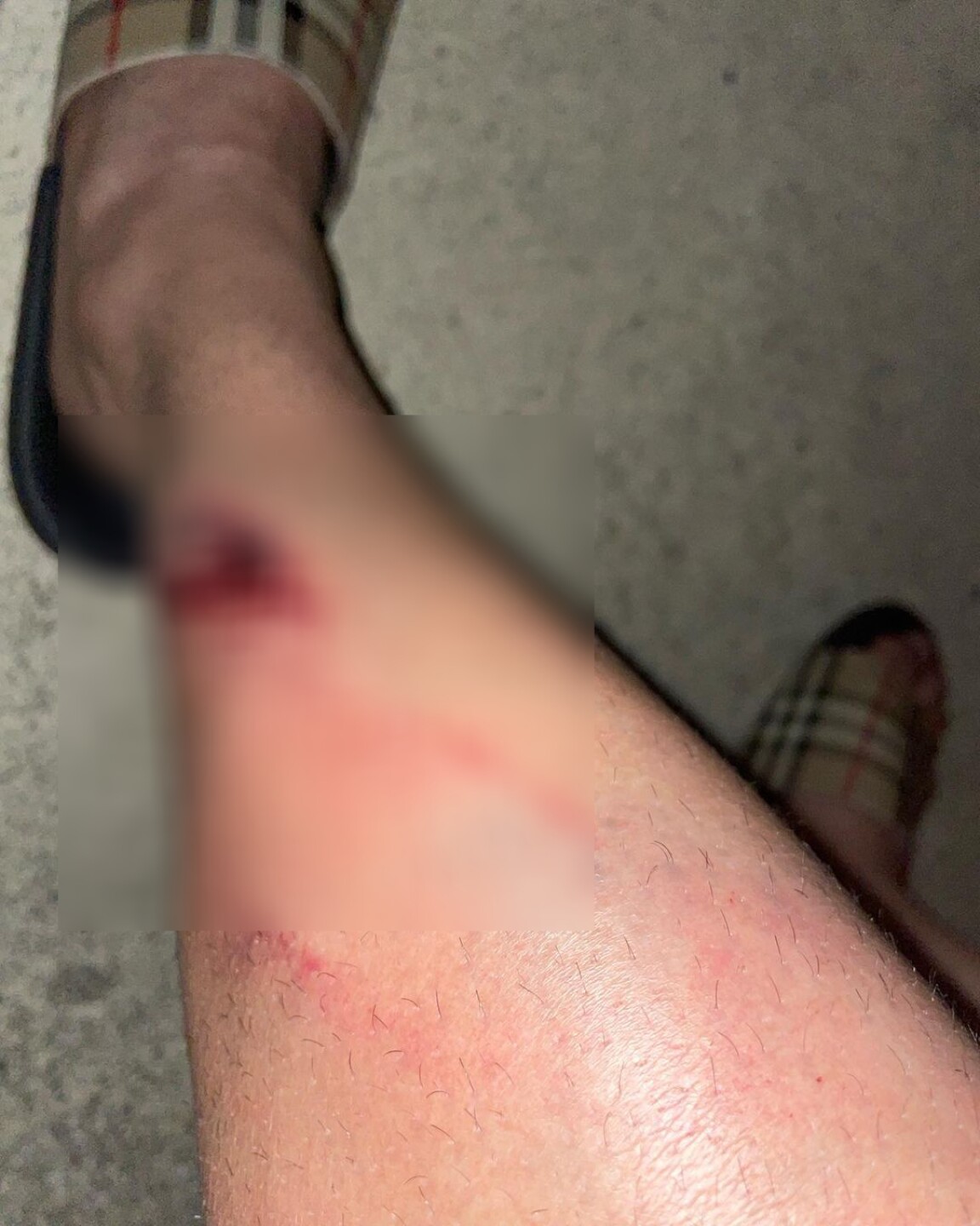 Tempo, accidente, lesión en pierna