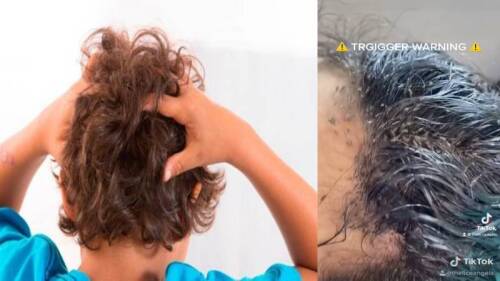 Niña tenía la cabeza infestada de piojos y causa terror en TikTok