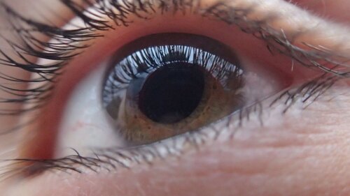 El galucoma se presenta cuando el nervio óptico se lesiona