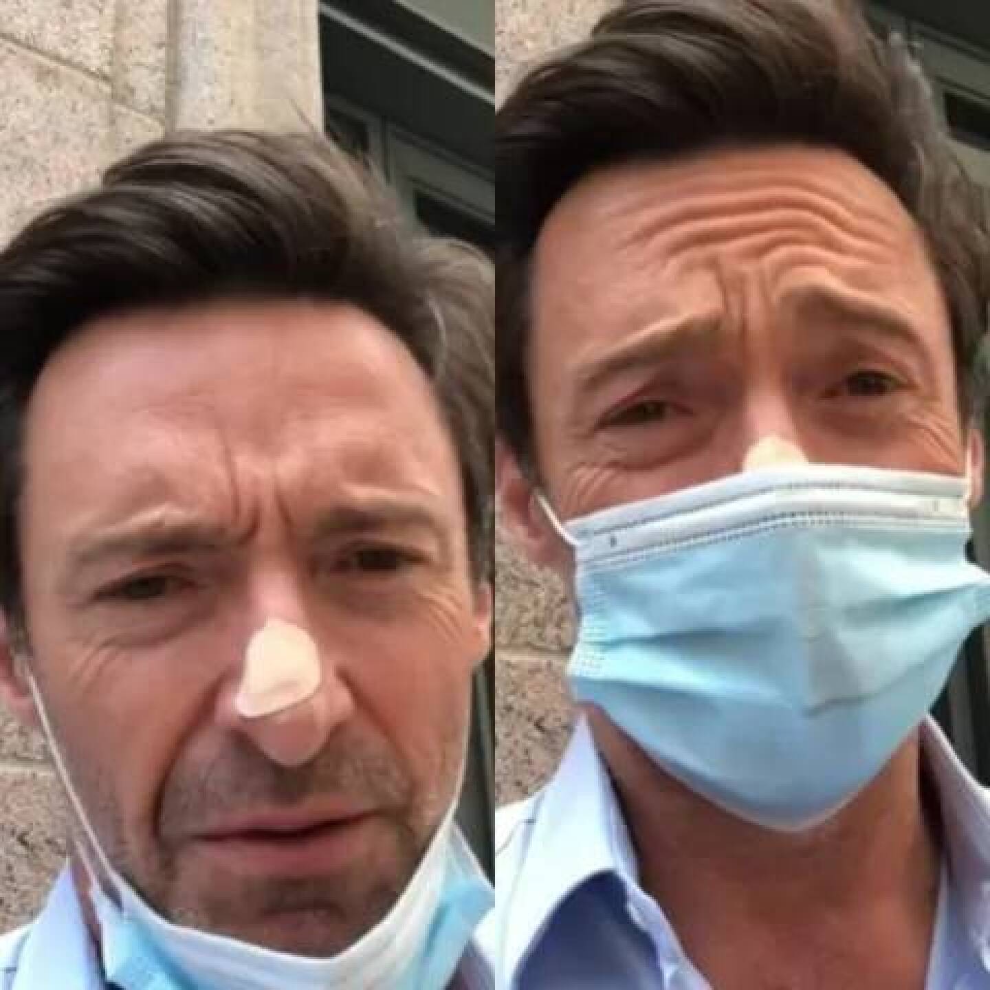 Hugh Jackman irregularidad en su nariz