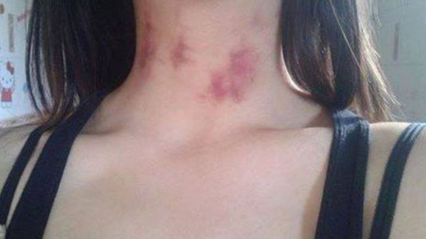 Le salieron extrañas marcas en el cuello y el pretexto a su novio fue