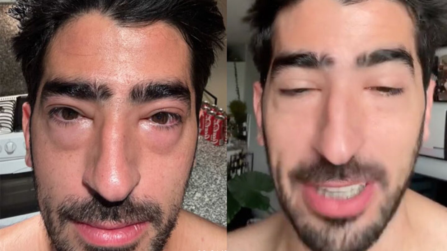 Jezzini con los ojos hinchados