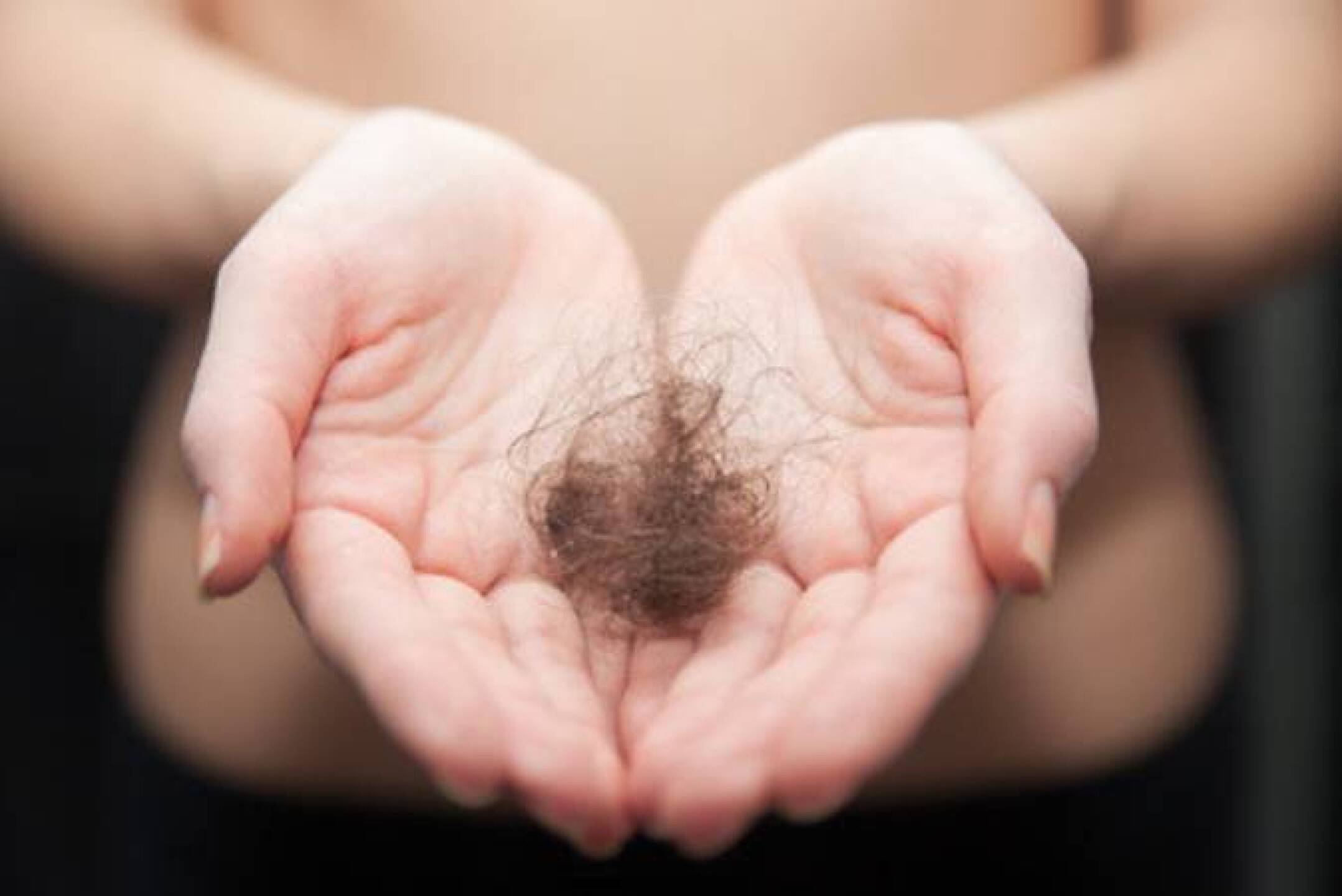 Alopecia femenina